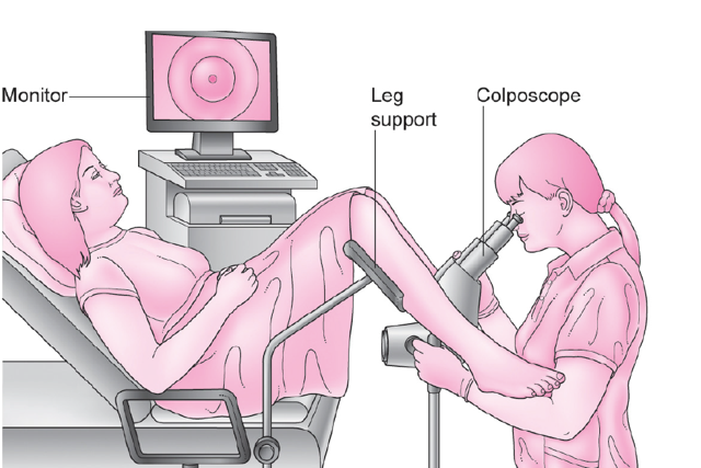 Colposcopy illustration