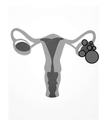 Ovarian Cysts